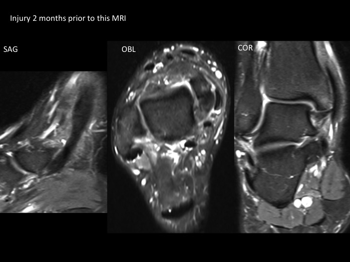 Figure 1 for case flexor retinaculum ( RID2313 )